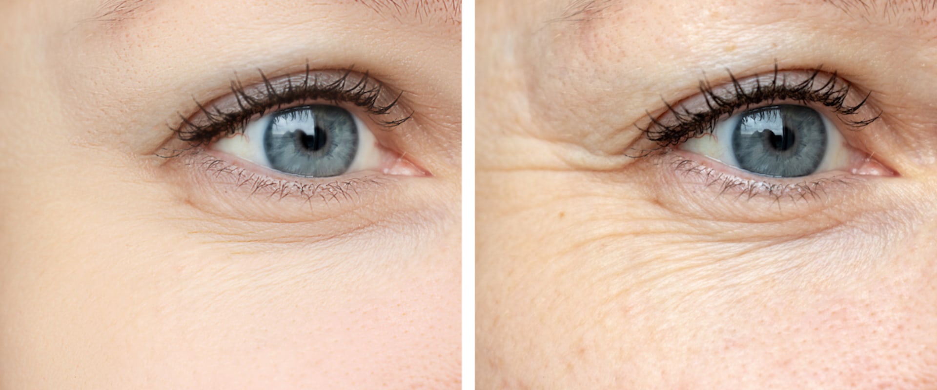Are Fillers Safer Than Botox? A Comprehensive Guide